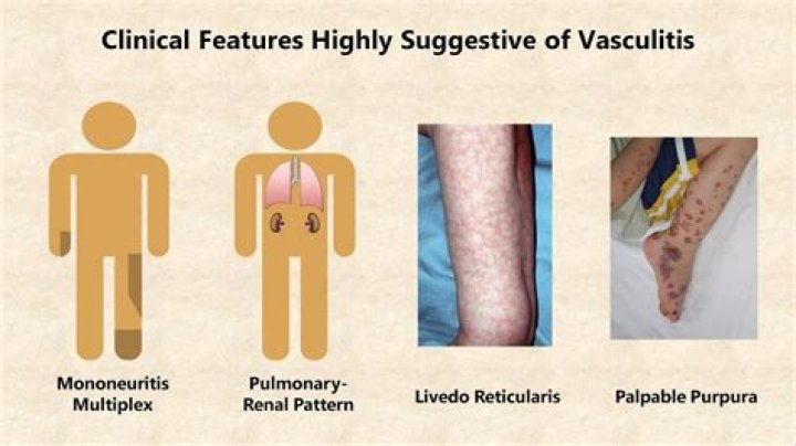 What causes Valvulitis